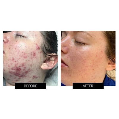 Dermalux Flex MD LED Ljusterapi Apparat