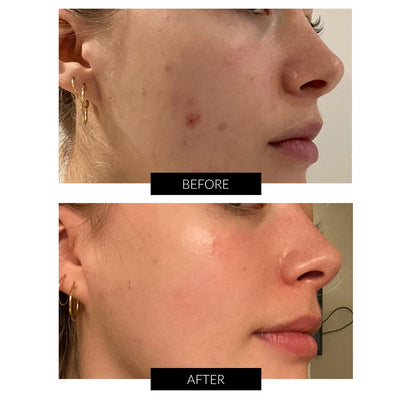 LYMA System Starter Kit + Gratis CurrentBody Skin Hudvård