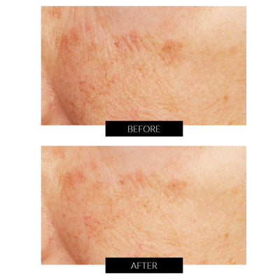 Lancer Caviar Lime Acid Peel with Glycolic Acid 50ml
