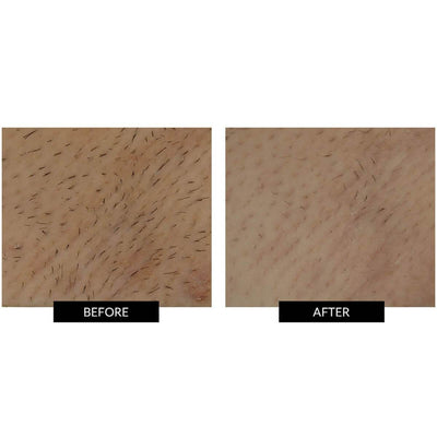 SmoothSkin Ultimate Hair Removal Kit