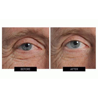 Nira Skincare Laser