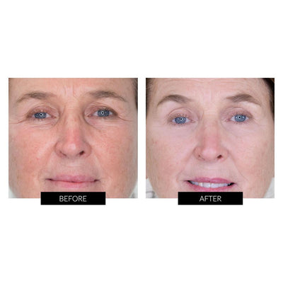 Nira Skincare Laser