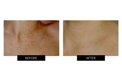 TriPollar STOP Facial Skin Renewal Device for improving wrinkles and facial toning before and after photos