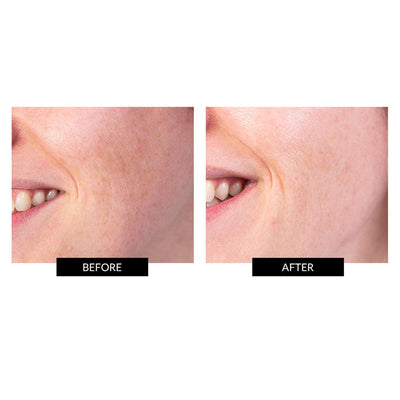 Before and after photos of the TriPollar STOP V Facial Renewal Device