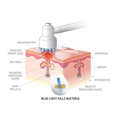 Quasar MD Baby Blue Acne Device