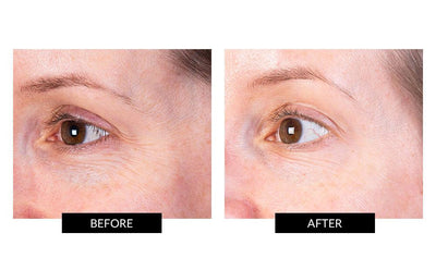 Nira Skincare Laser