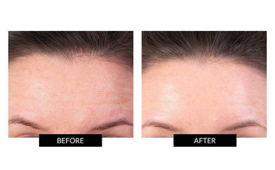 TriPollar STOP Facial Skin Renewal Device for improving wrinkles and facial toning before and after photos
