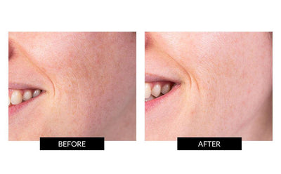 Before and after photos of the TriPollar STOP X Rose Gold Device
