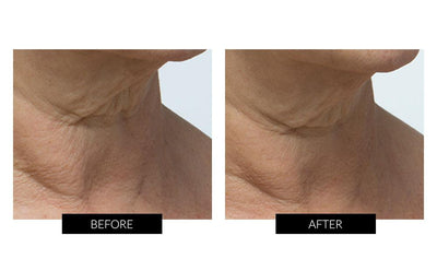 Trophy Skin MiniMD Handheld Portable Microdermabrasion Device