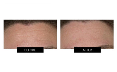 Trophy Skin MiniMD Handheld Portable Microdermabrasion Device