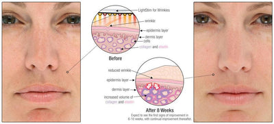 LightStim for Wrinkles